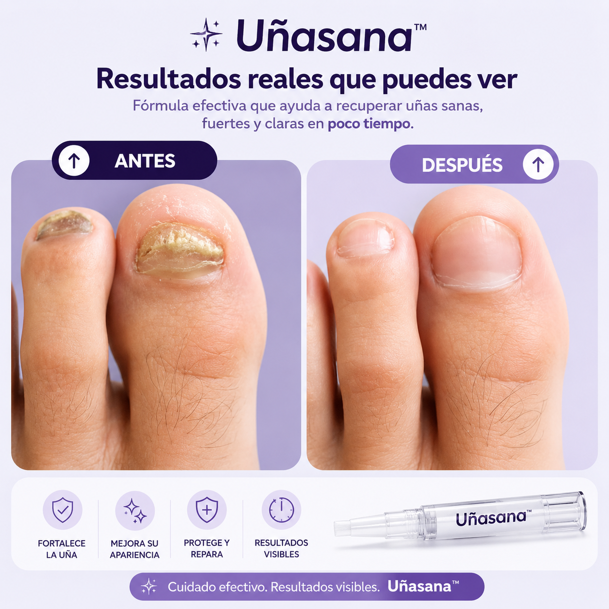 Uñasana™ | Lápiz Antihongos